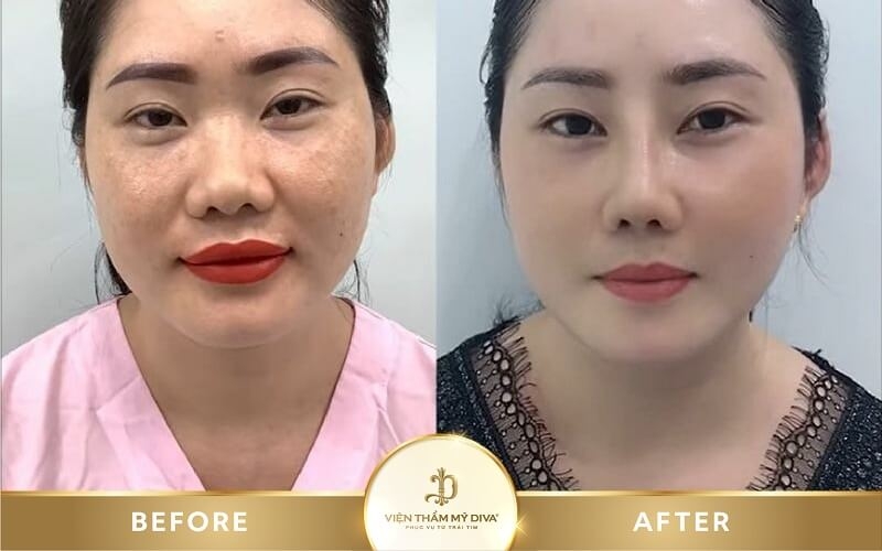 Khách hàng thực hiện thu gọn cánh mũi tại Viện thẩm mỹ DIVA