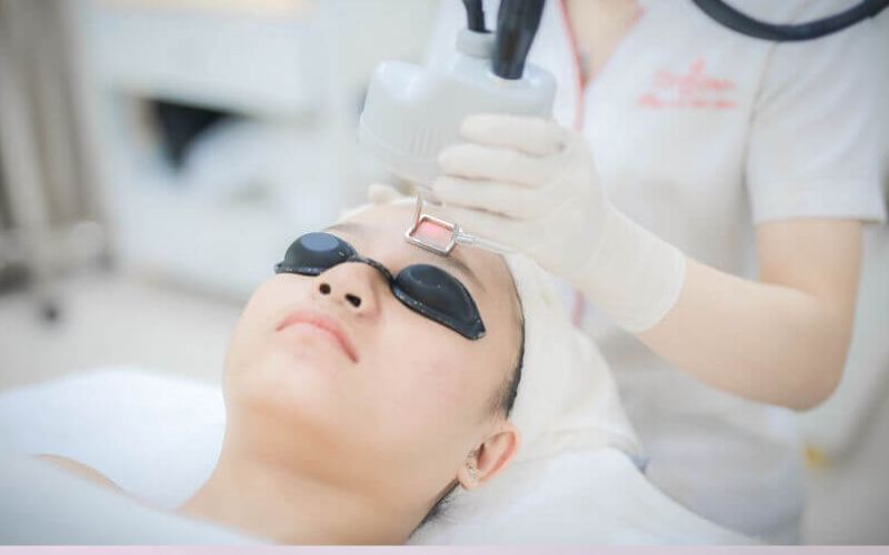 Điều trị đốm nâu bằng laser