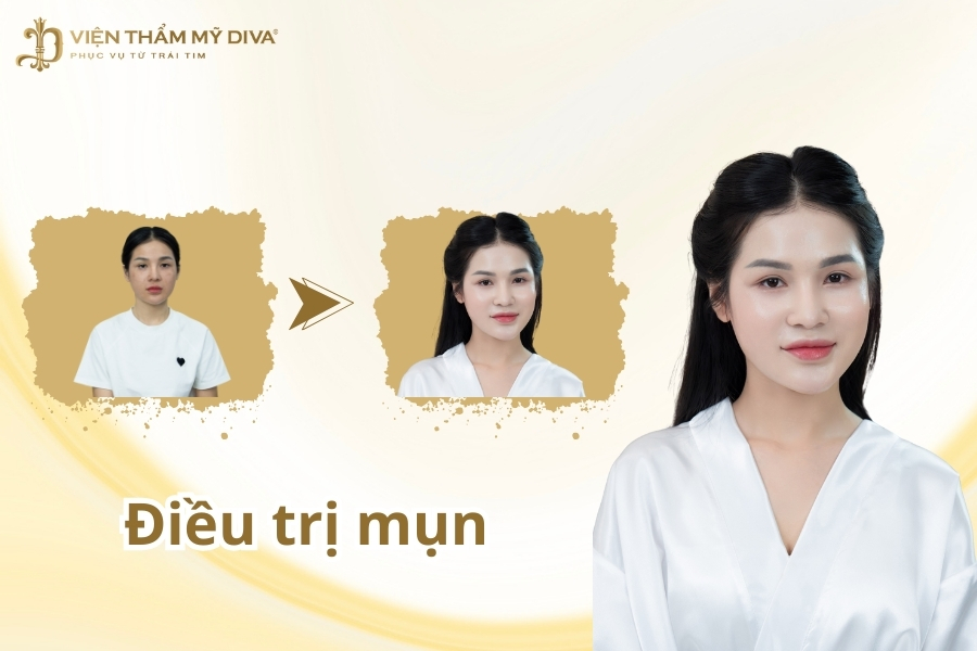  Điều Trị Mụn: Giải Pháp Cho Làn Da Sạch Mụn Và Khỏe Mạnh