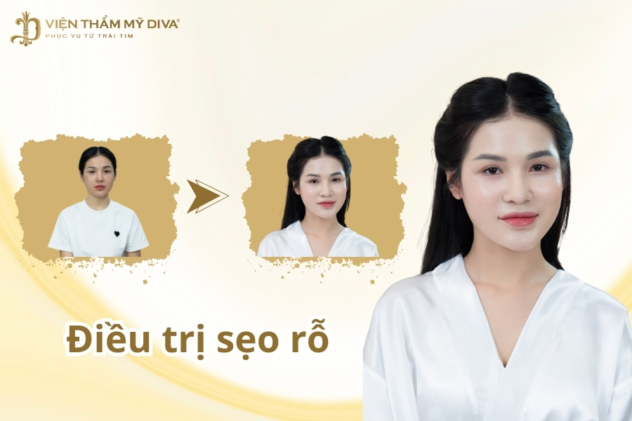 Điều trị sẹo rỗ - Nguyên nhân, bí quyết chăm sóc và các lưu ý