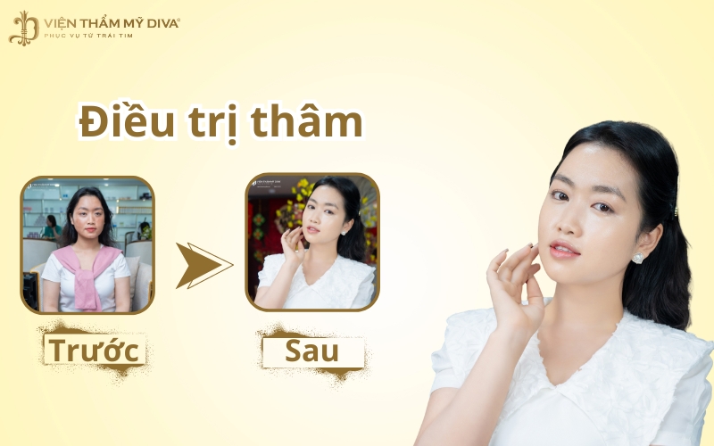 Điều trị thâm: Giải pháp cho làn da sáng mịn, không tì vết