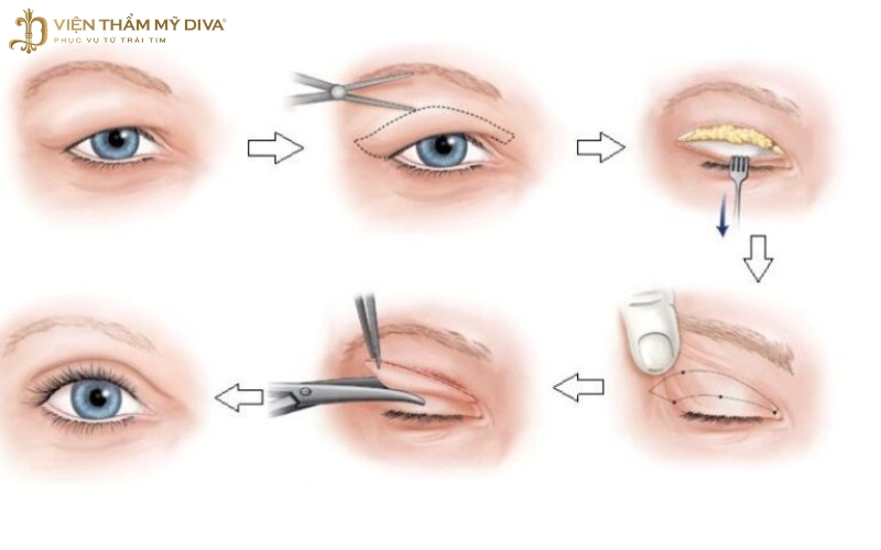 Cắt Mí Mắt: Mọi Điều Bạn Cần Biết Về Phẫu Thuật Thẩm Mỹ Mắt 12