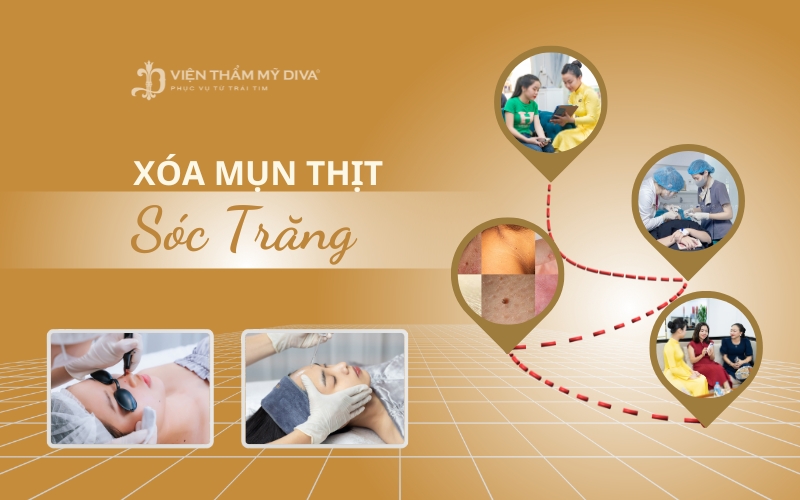 Top 5 Địa Chỉ Xóa Mụn Thịt An Toàn Ở Sóc Trăng