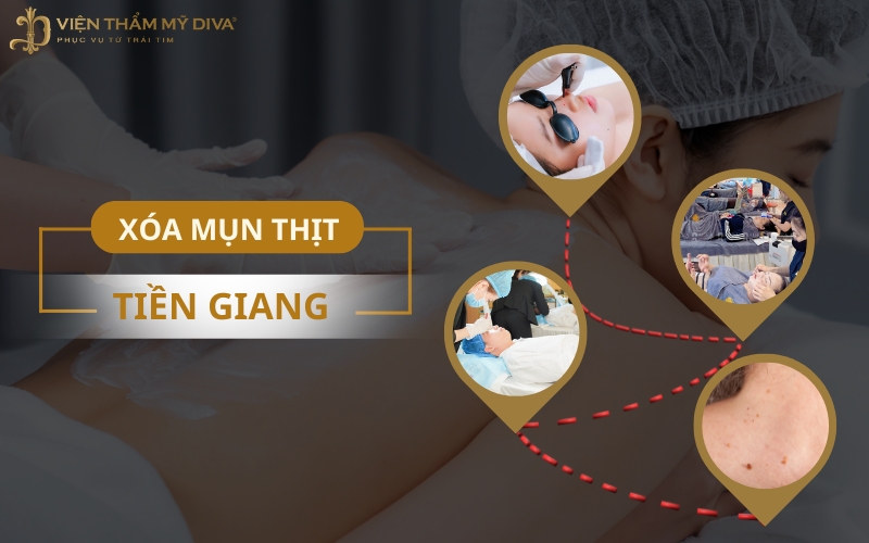 Xóa Mụn Thịt Tiền Giang Ở Đâu? Gợi Ý Top Cơ Sở Da Liễu Tốt Ở Tiền Giang