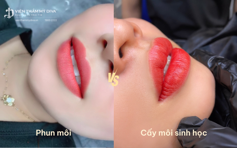 Cấy môi sinh học là gì? Nên phun môi hay cấy môi sinh học? 5 Hai kỹ thuật làm đẹp môi phổ biến hiện nay được ưa chuộng