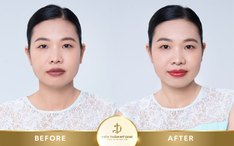 trước sau làm đẹp