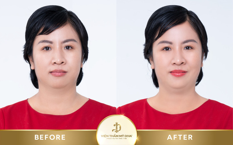 trước sau làm đẹp