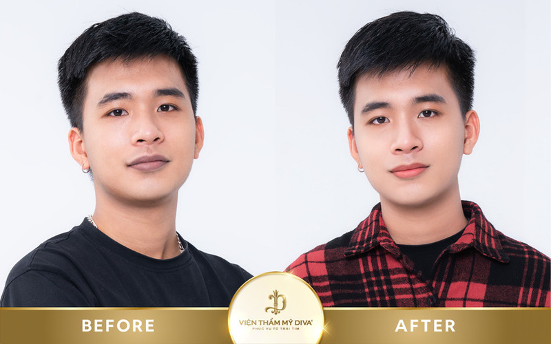 trước sau làm đẹp