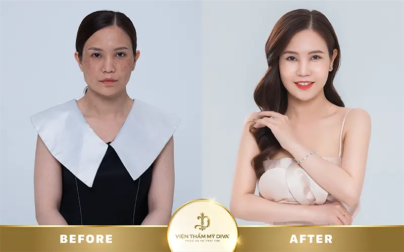 trước sau làm đẹp