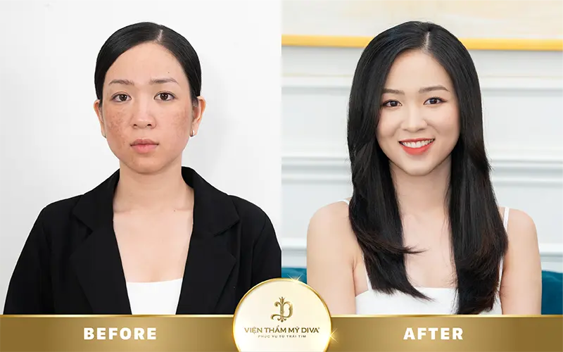 trước sau làm đẹp