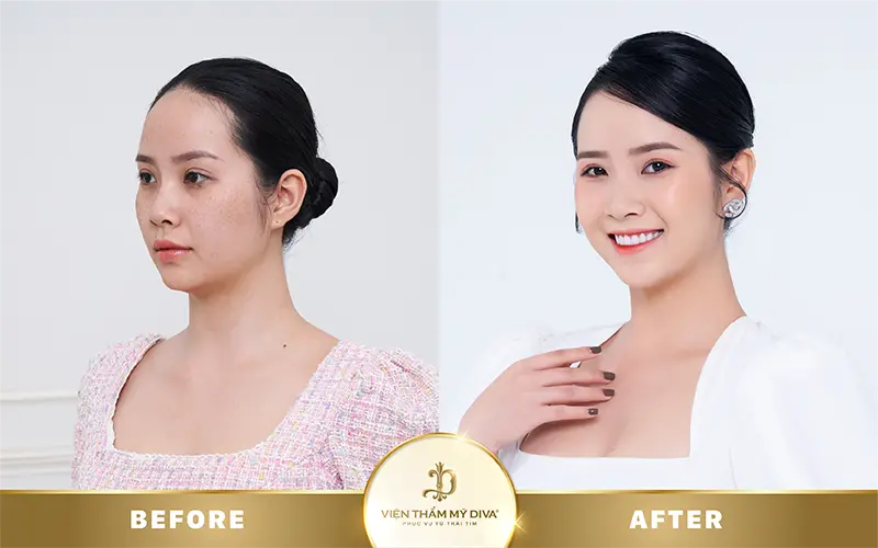 trước sau làm đẹp