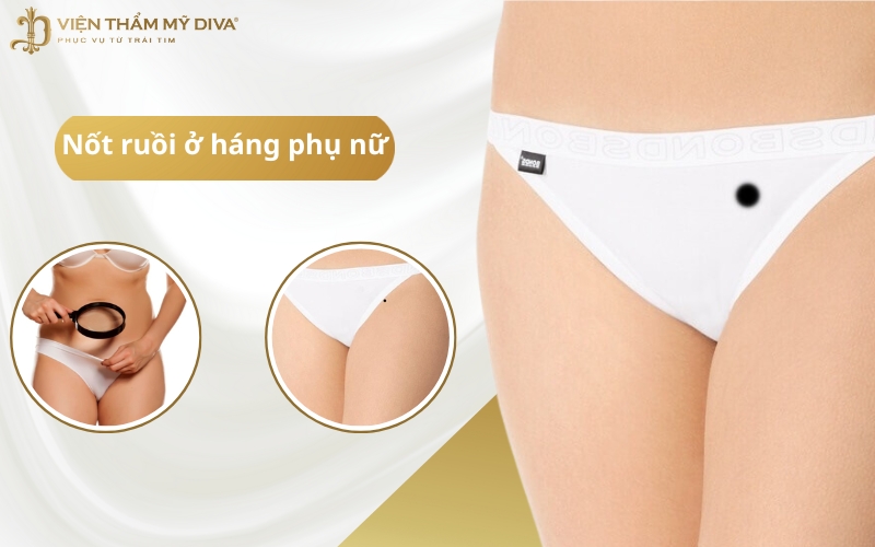 Ý Nghĩa Nốt Ruồi Ở Háng (Bẹn): May Mắn, Giàu Sang & Vượng Phu Ích Tử?