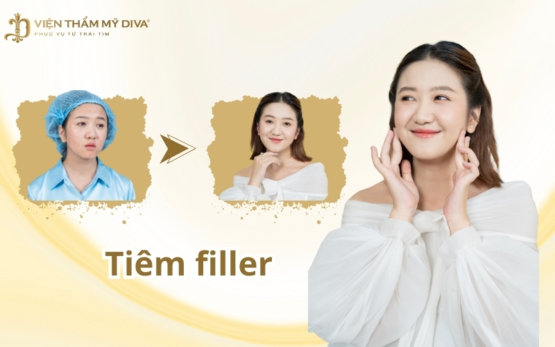 Tiêm Filler là gì? Nguy hiểm không? Giá bao nhiêu?