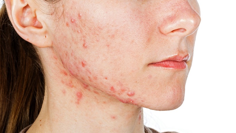 mụn gây ảnh hưởng thẩm mỹ