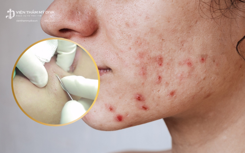 Phương pháp cắt đáy sẹo giúp làm phẳng da, sẹo rỗ lâu năm