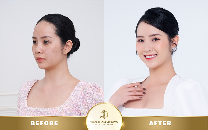 Làm đẹp tại Viện thẩm mỹ DIVA Phước Long