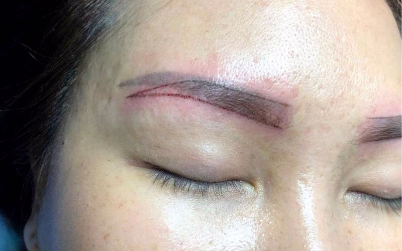 Sửa lông mày hỏng - Cách khắc phục lỗi phun mày nhanh chóng 4 Lông mày phun xăm bị trổ đỏ gây mất thẩm mỹ cho nhiều chị em