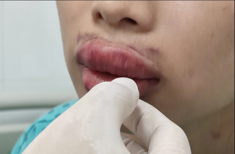 phun-moi-tai-thot-not Hậu quả của việc chọn cơ sở phun môi "giá rẻ"