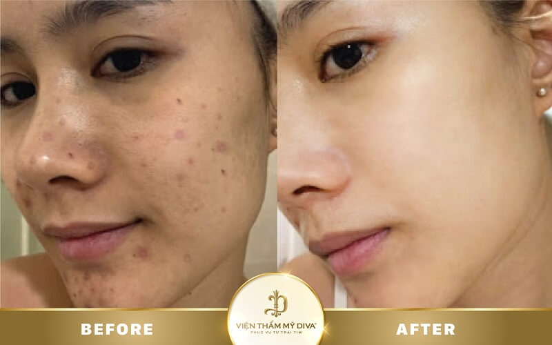 Điều trị mụn tại Viện thẩm mỹ DIVA