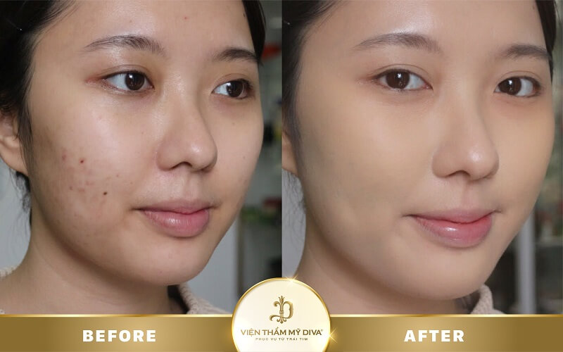 trị mụn hiệu quả