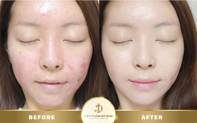 trị mụn ở bến cát