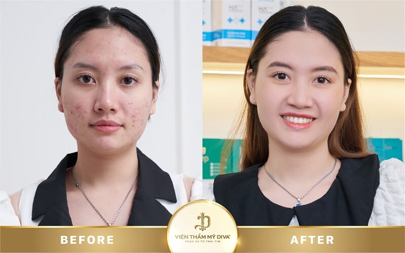 Làm đẹp tại Viện thẩm mỹ DIVA Phước Long