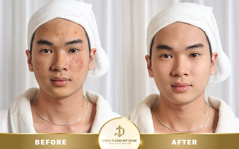 trị mụn tại bến cát