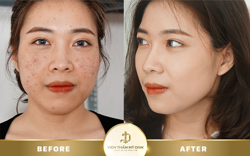 trị mụn bến cát