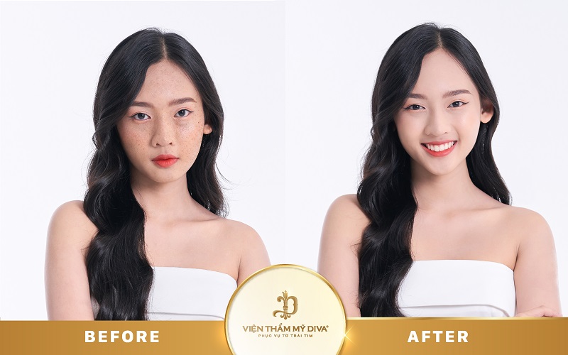 Làm đẹp tại Viện thẩm mỹ DIVA Phước Long