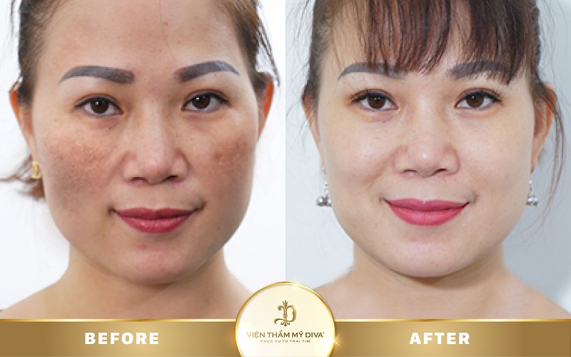 trị nám tại dĩ an