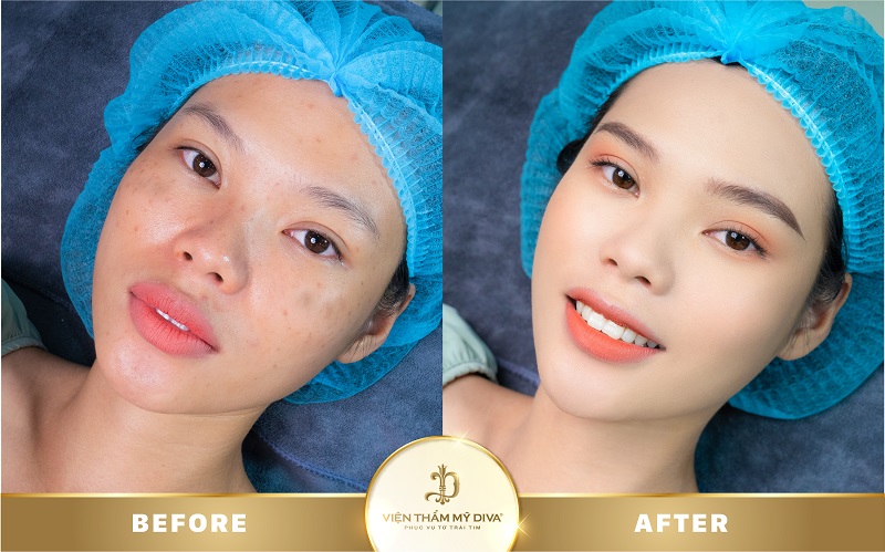 Làm đẹp tại Viện thẩm mỹ DIVA Phước Long