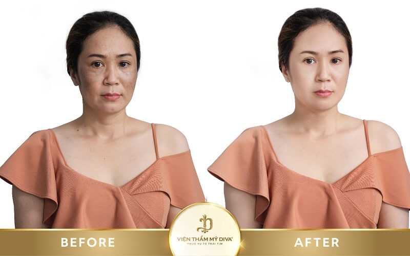 trước sau làm đẹp