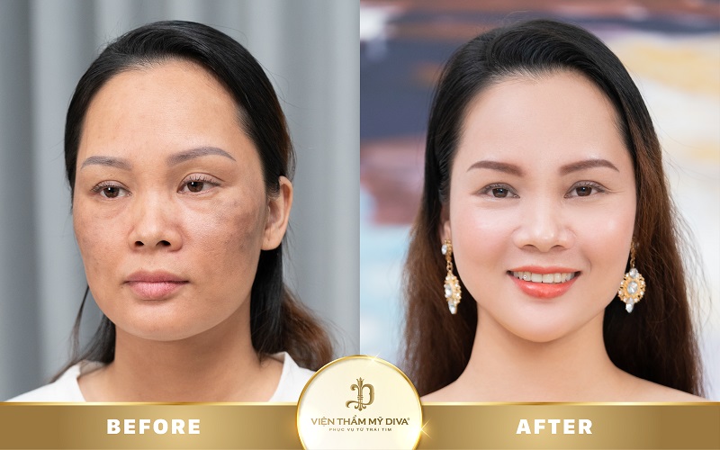 trị nám an toàn