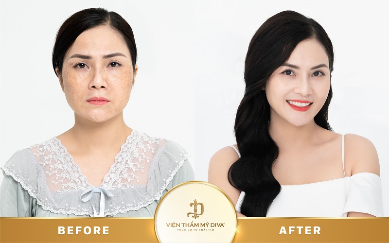 Làm đẹp tại Viện thẩm mỹ DIVA Phước Long