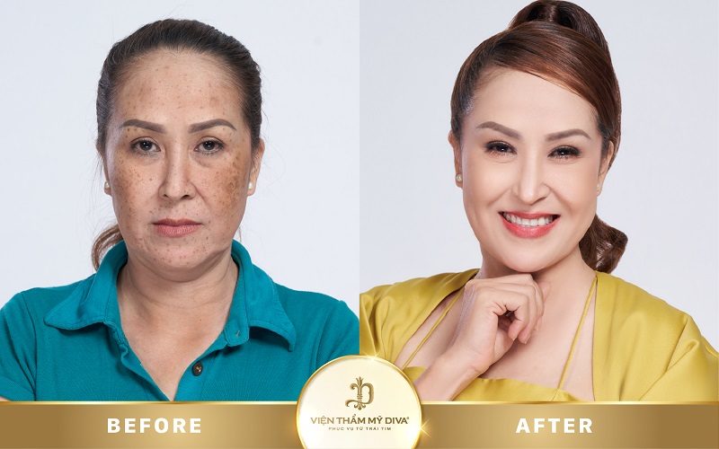 Làm đẹp tại Viện thẩm mỹ DIVA Phước Long