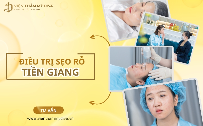 Top 7 Địa Chỉ Điều Trị Sẹo Rỗ An Toàn Tại Tiền Giang