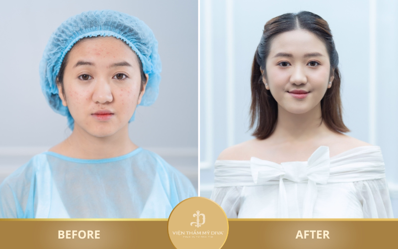 Hình ảnh trước và sau khi thực hiện liệu trình chăm sóc da của khách hàng tại DIVA