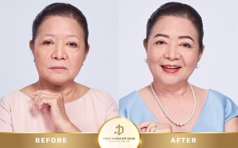 Hình ảnh của khách hàng trước và sau khi phun môi tế bào gốc