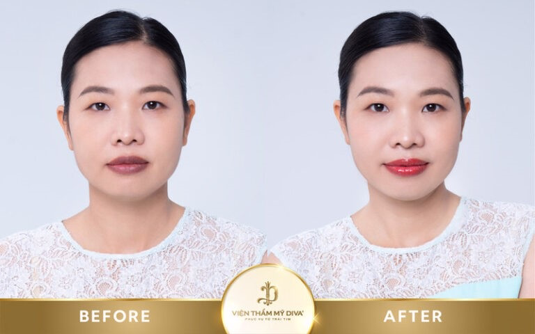 Hình ảnh của khách hàng trước và sau khi phun môi tế bào gốc