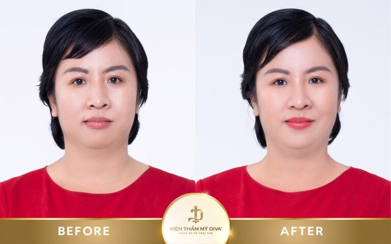 Hình ảnh của khách hàng trước và sau khi phun môi tế bào gốc
