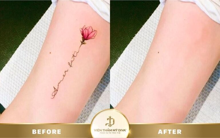 Hướng dẫn xóa hình xăm - An toàn và hiệu quả 3