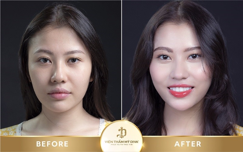 Hình ảnh khách hàng sau khi phun môi vi chạm tại Viện thẩm mỹ DIVA
