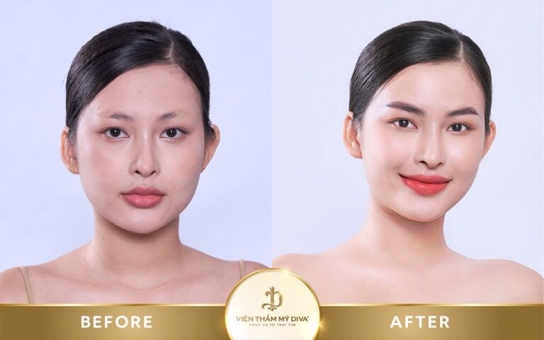 Hình ảnh khách hàng sau khi phun môi vi chạm tại Viện thẩm mỹ DIVA
