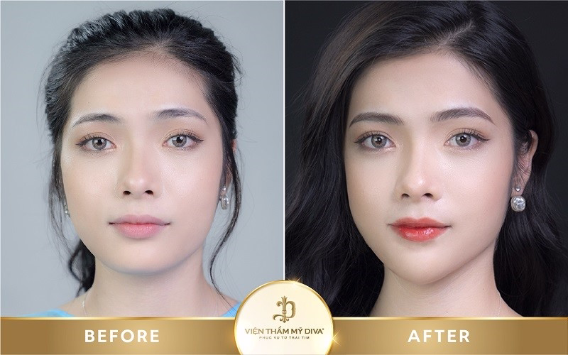 Hình ảnh khách hàng sau khi phun môi vi chạm tại Viện thẩm mỹ DIVA