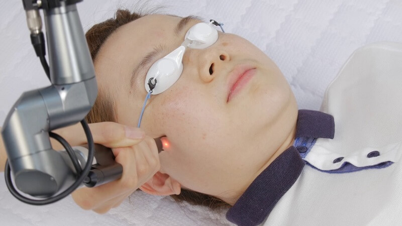 tri-mun-o-thot-not trị mụn bằng laser