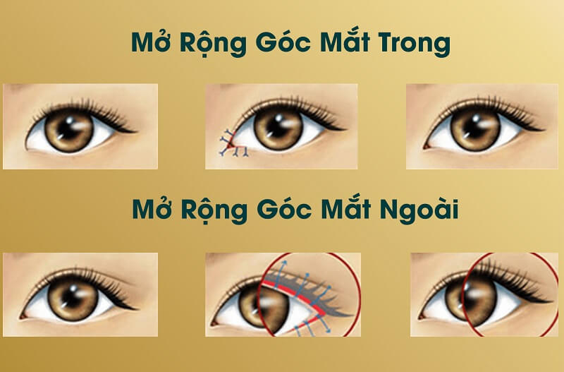 mo-goc-mat-o-can-tho mo-goc-mat-o-can-tho-1