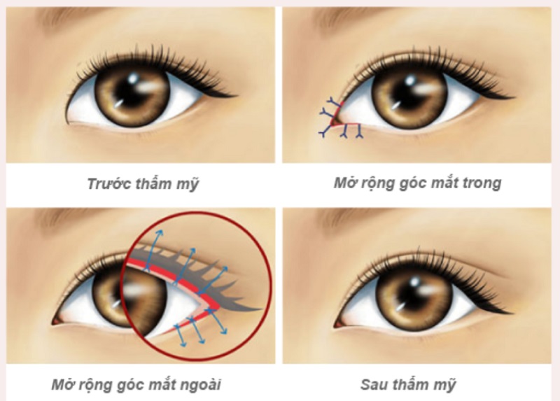 mo-goc-mat-o-dau-dep-2