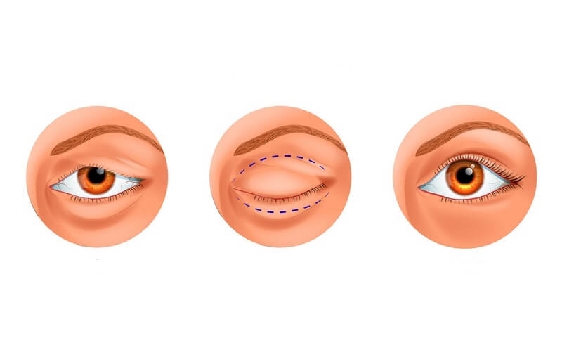 mo-goc-mat-o-dau-dep-1