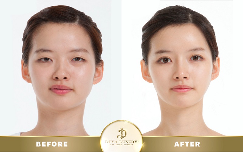 mo-goc-mat-o-dau-dep-4