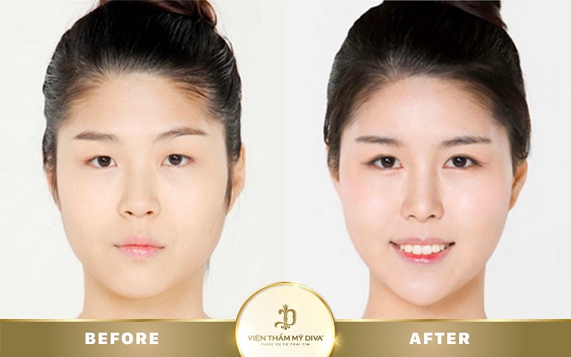 mo-goc-mat-o-can-tho mo-goc-mat-o-can-tho-3